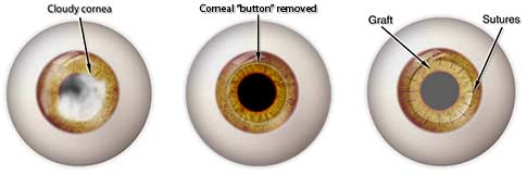 Corneal Transplant