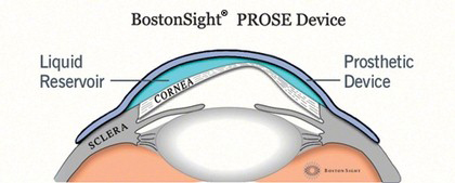 Cataract