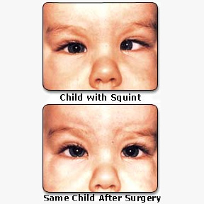 Paediatric Ophthalmology & Strabismus